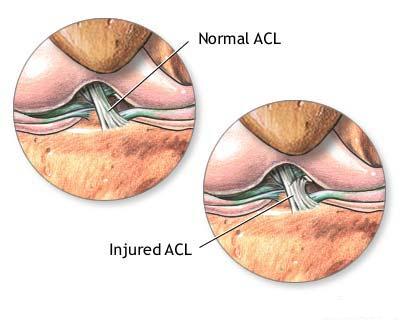 Ligament incrucisat anterior - leziuni 3