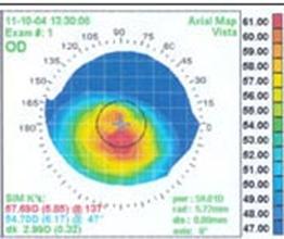 Image:Corneal topography right ax.jpg